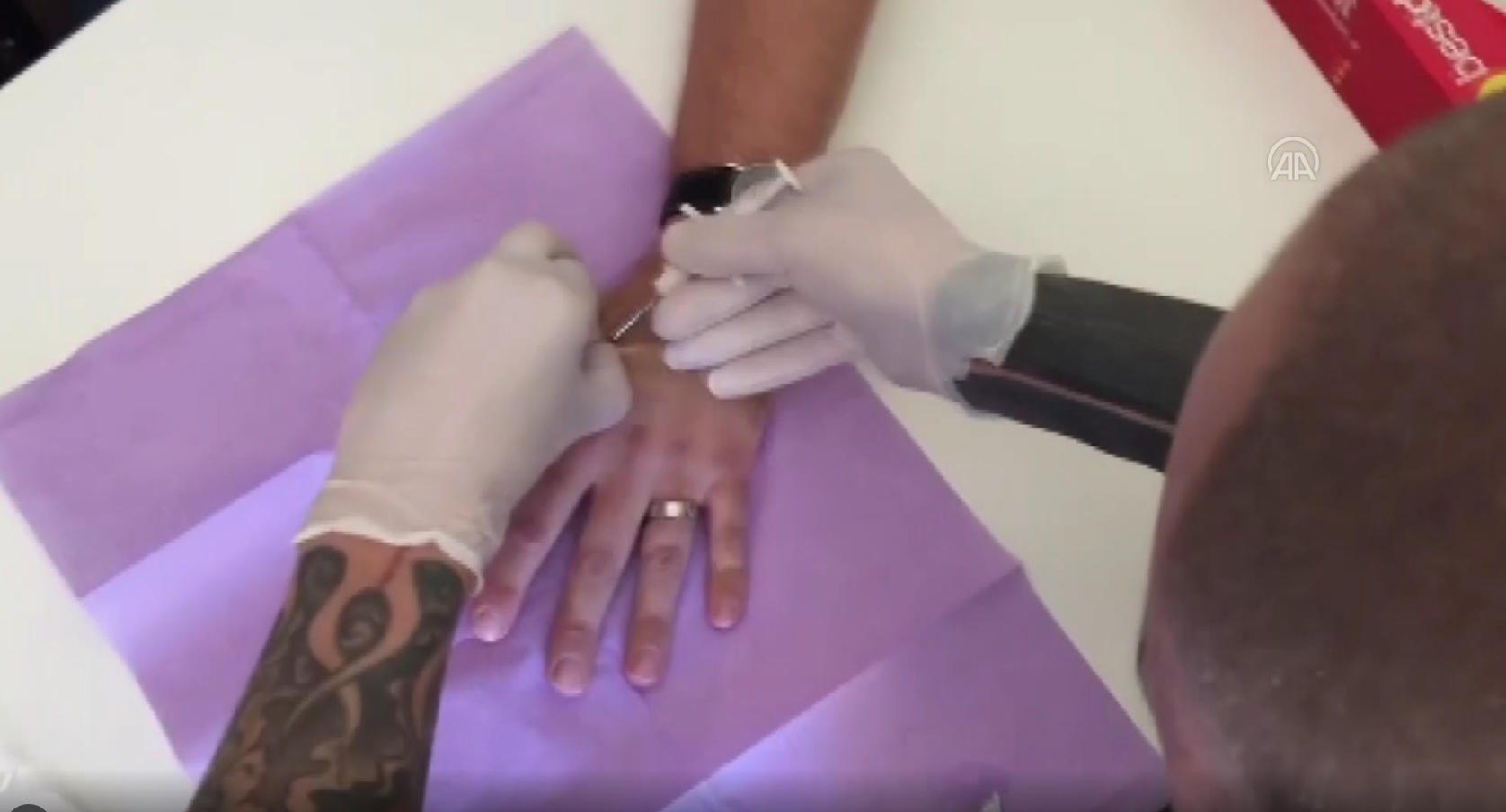 Se operan de sus manos para establecer los microchips por tener 'el pasaporte de vacuna'