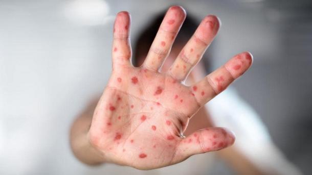 Epidemija ospica: Na Filipinima desetine mrtvih i oboljelih