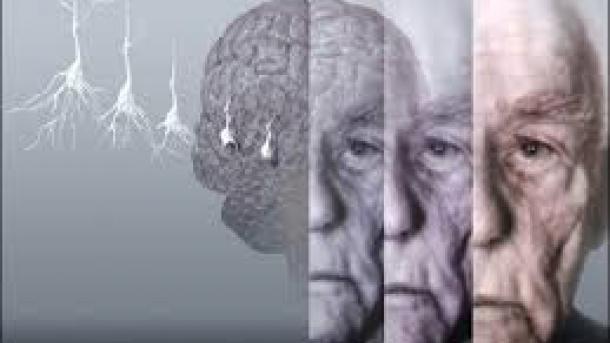 Si të parandalojmë dhe përballemi me Alzheimerin, sëmundja e shekullit