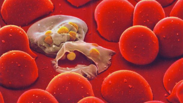Malaria yazua hofu nchini Indonesia
