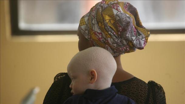 Burundi : Le double mal des albinos
