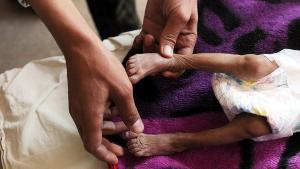یمن، خستهلیکلرله ده مبارزه ائدیر