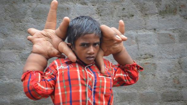 بھارتی بچے کے عجیب الخلقت ہاتھ