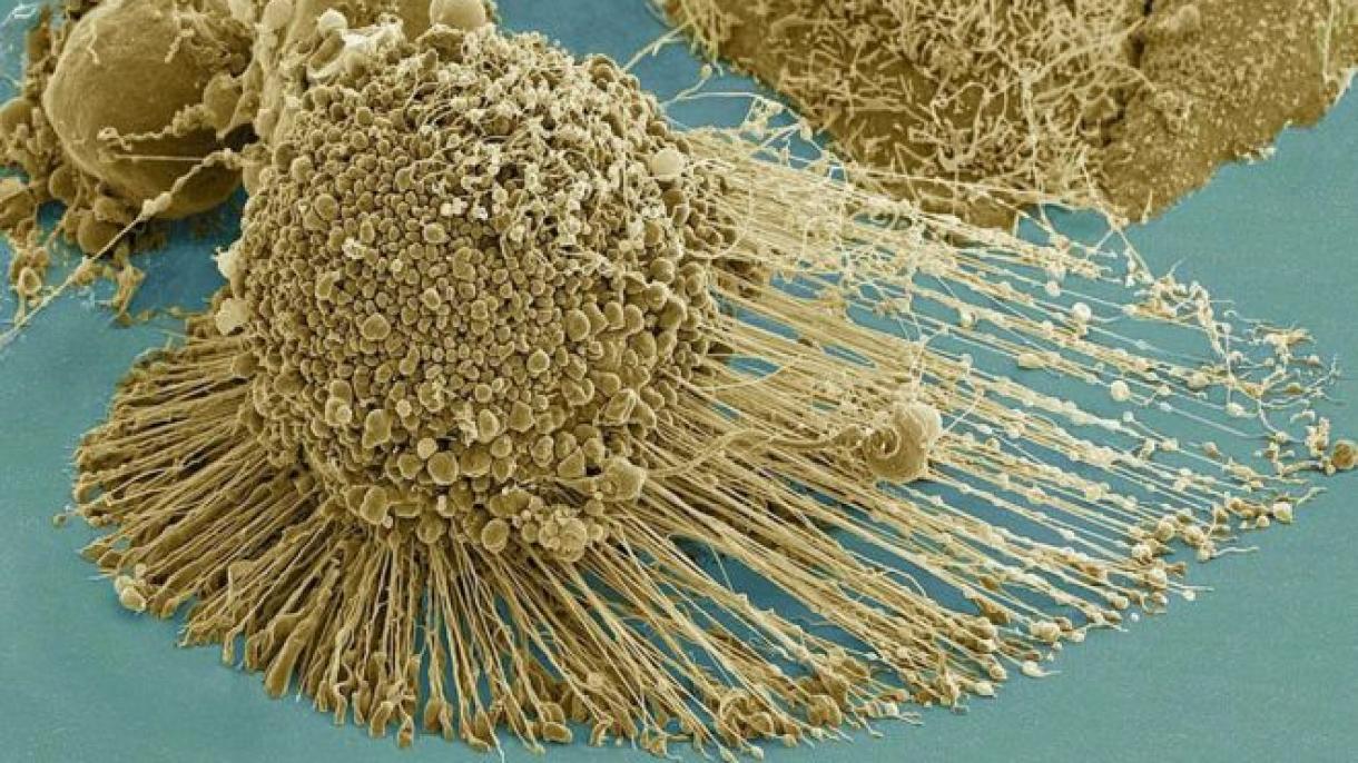 Fue descubierto un biomarcador que pronostica la progresión del mieloma asintomático