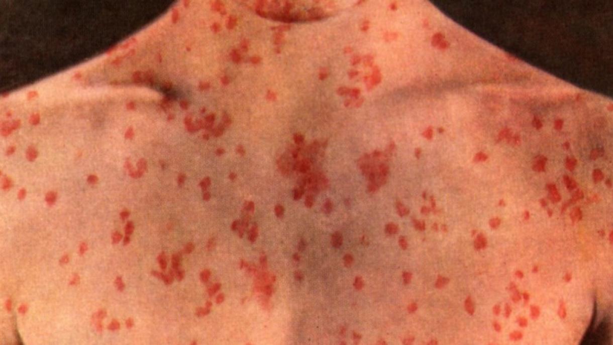 Əlcəzayirdə Qızılca epidemiyası sürətlə yayılır