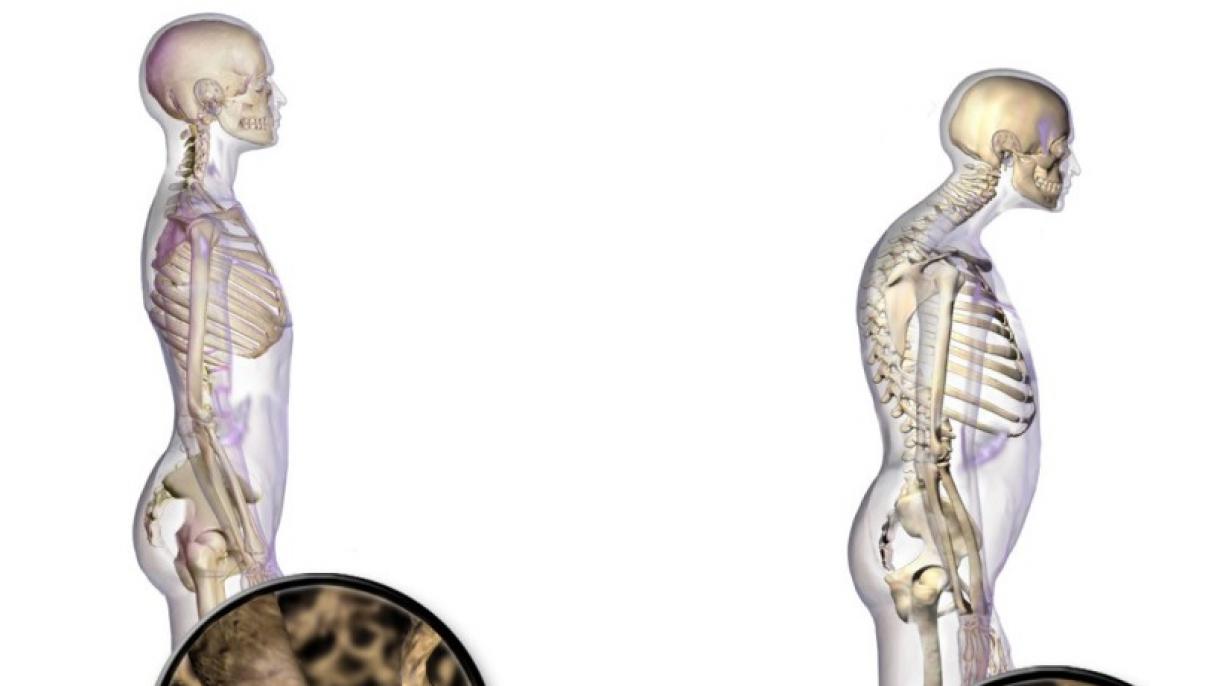 Una de cada cuatro mujeres postmenopáusicas padece de osteoporosis