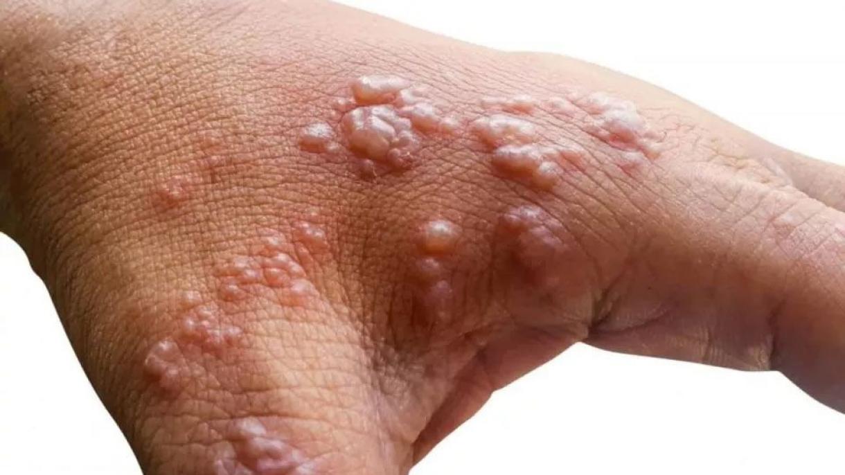 世卫组织:猴痘确诊病例近1万例