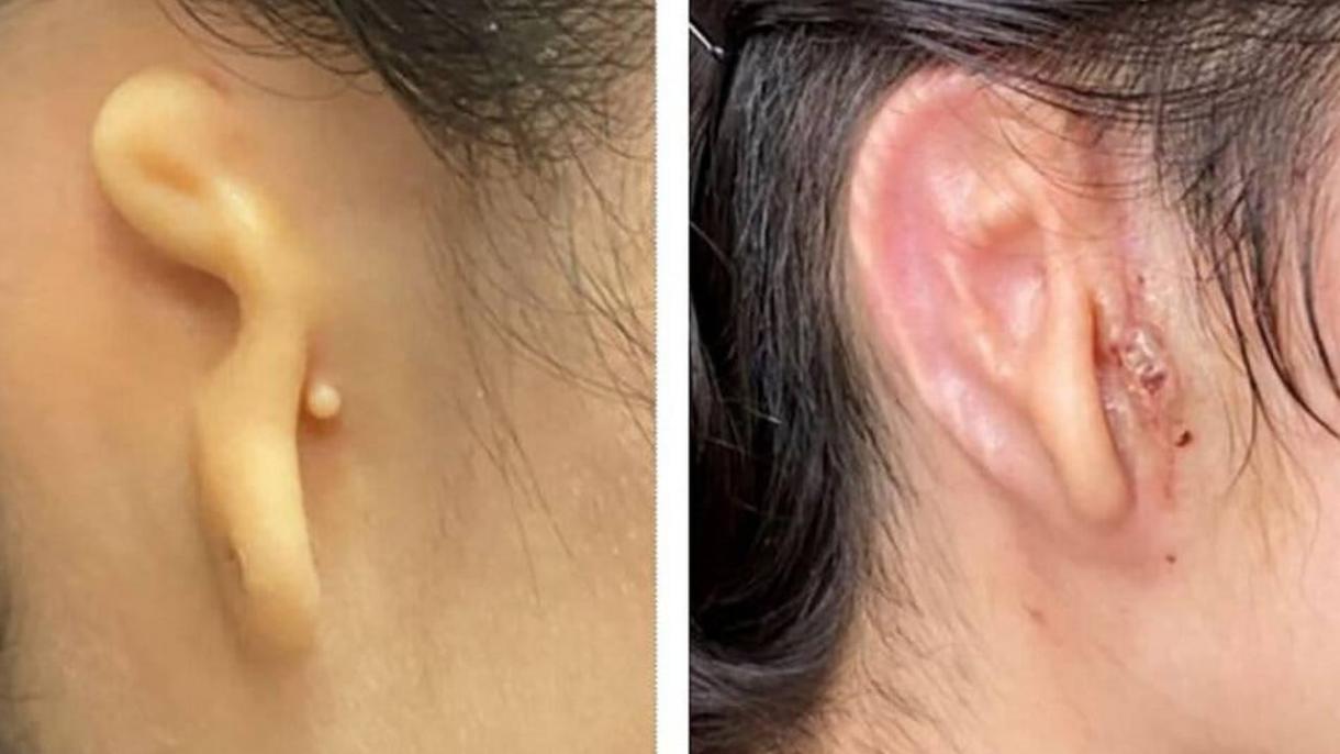 Consiguen implantar por primera vez una oreja impresa en 3D creada con células humanas
