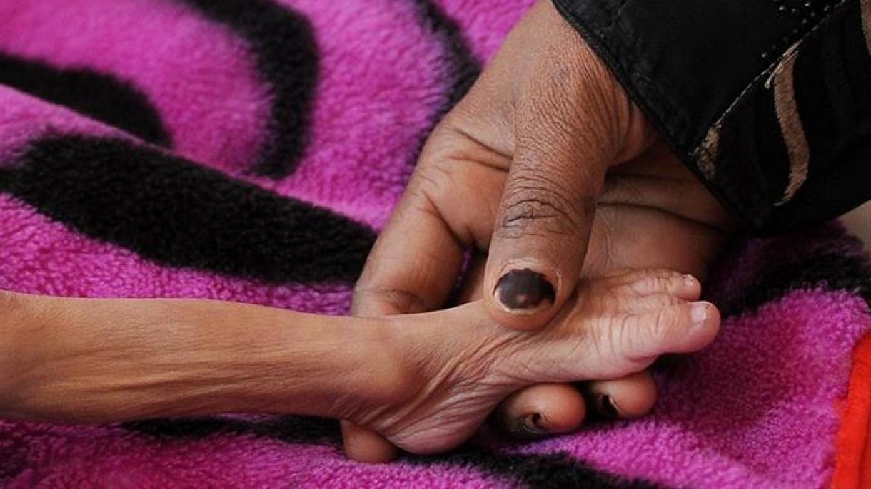 سازمان ملل متحد: سو تغذیه و بیماری جان هزاران کودک یمنی را تهدید میکند