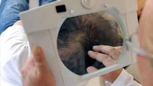 Turska glavna destinacija za transplantaciju kose
