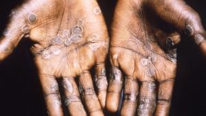 尼日利亚猴痘疫情持续 19人死亡