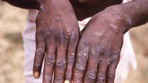 Kongoda mpox (maymıl çäçäge) kizüe başlandı