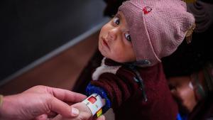 تقریبا 900 هزار کودک در افغانستان در معرض سوءتغذیه شدید هستند