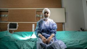 دختر سوری که پوست سرش کنده شده بود، ترکیه درمان شد