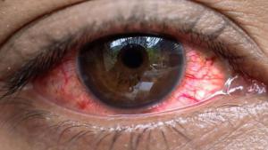 یوگنڈا: ملک بھر میں آشوبِ چشم کی وباء، مریضوں کی تعداد ہزاروں تک پہنچ گئی