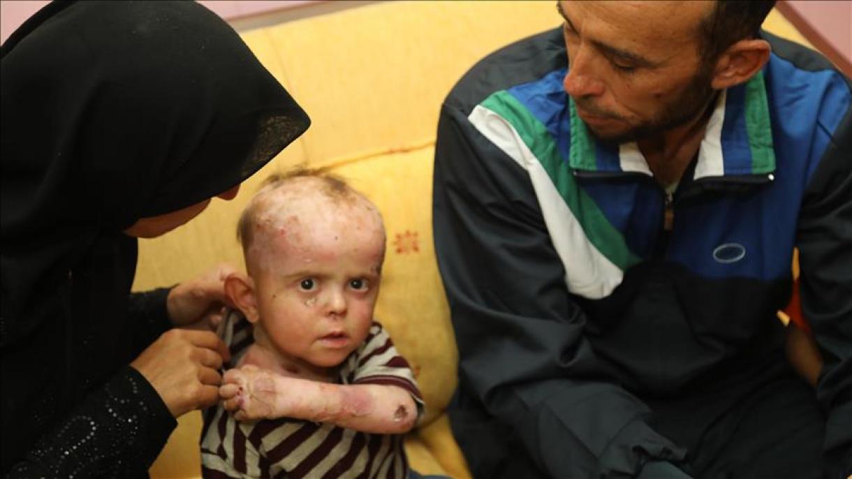 درمان کودک بیمار سوری در ترکیه