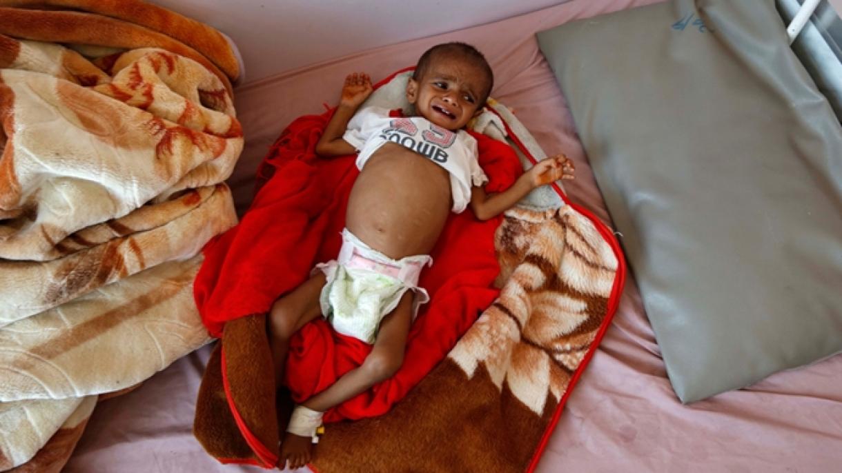 صدها هزار کودک یمنی از سوء تغذیه رنج می‌برند