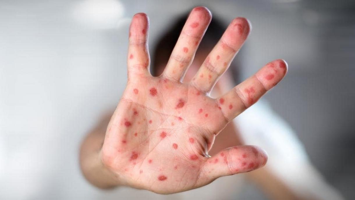 菲律宾出现麻疹疫情