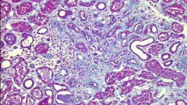 Nueva terapia contra la fibrosis renal