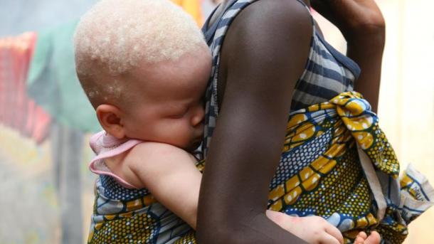 Especialista da ONU investigará ataques contra pessoas com albinismo na Tanzânia