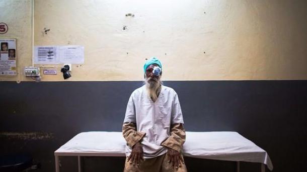 بھارت میں صحت کا ایک اور سکینڈل۔ 15افراد نابینا ہوگئے