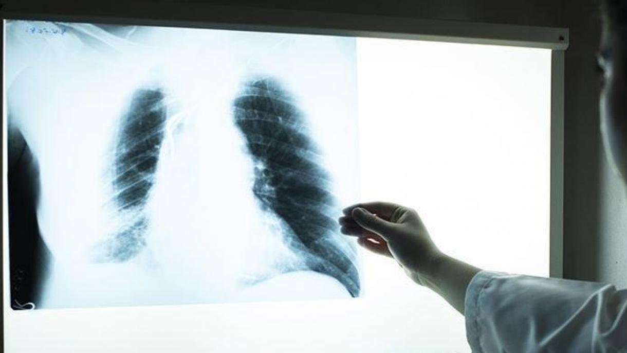 Növekedni kezdett a tuberkulózisos esetek száma