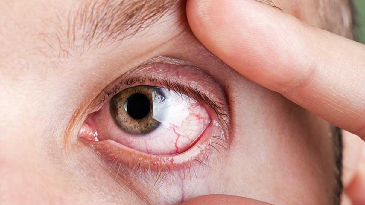 Älem giňişliginde öndürilen retina körlügi bejerip biler