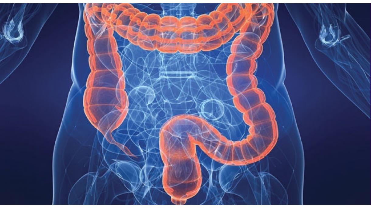 El síndrome del intestino irritable es una enfermedad crónica que afecta al sistema digestivo