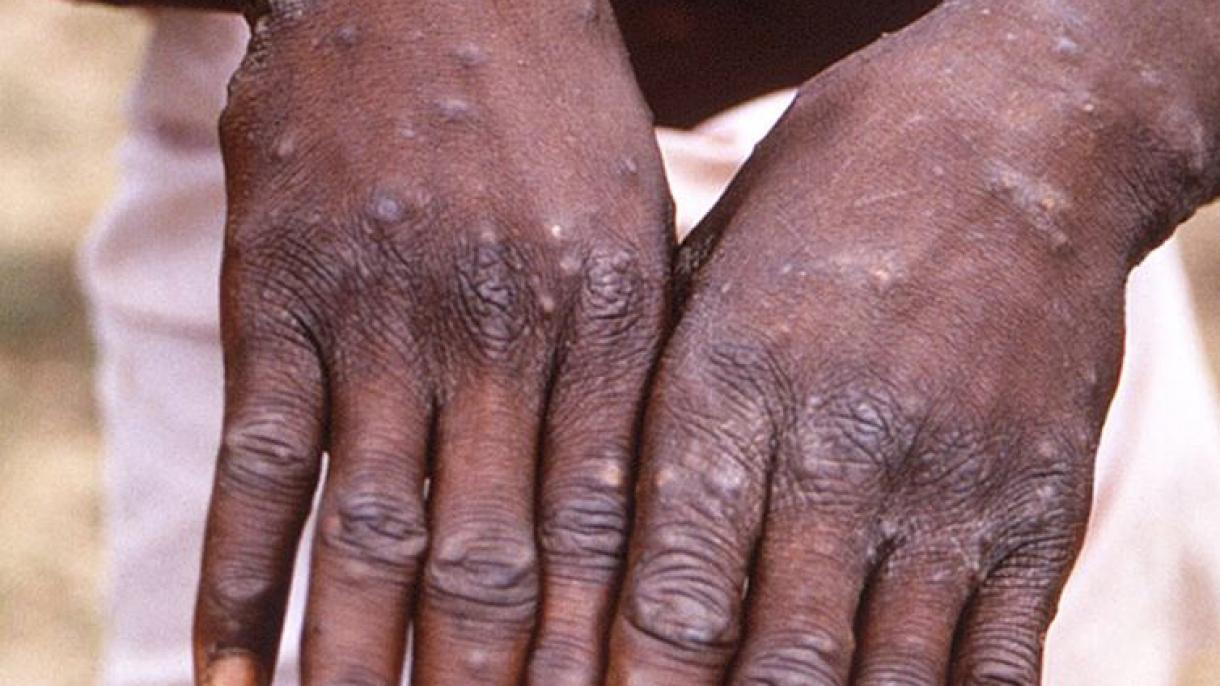 O persoană infectată cu variola maimuței a murit în Nigeria