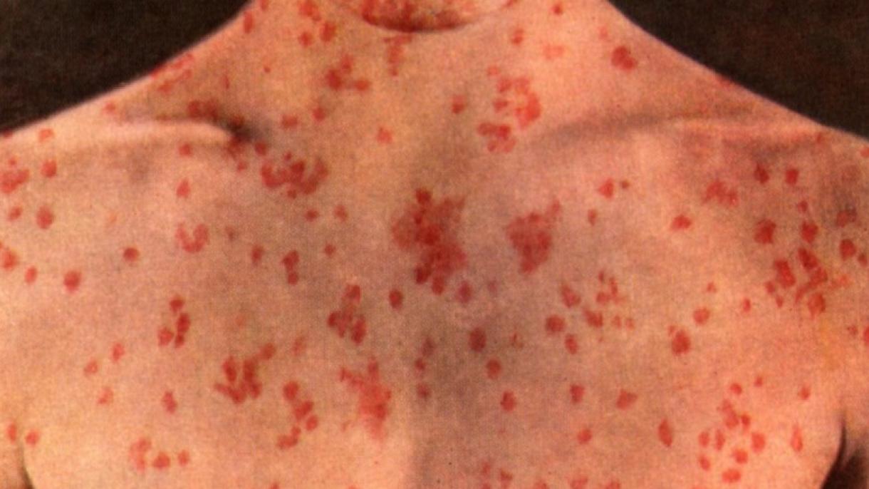 阿尔及利亚麻疹疫情继续蔓延