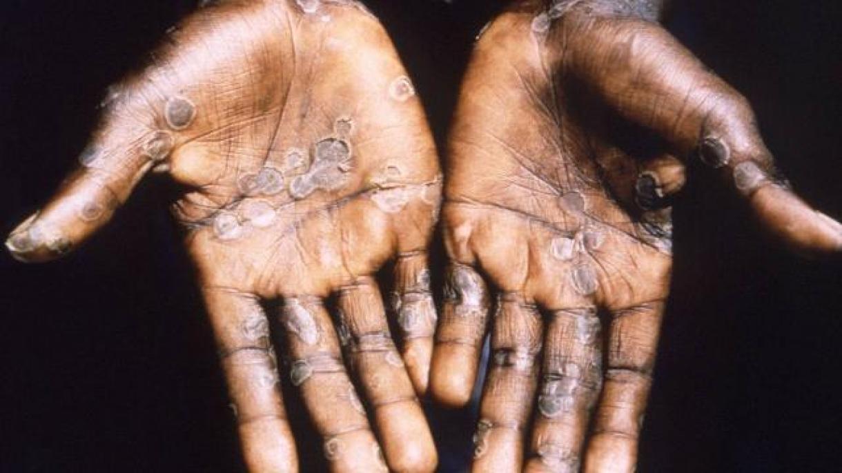 Wenesuelada Maýmyn Mama Keseli Hasaba Alyndy