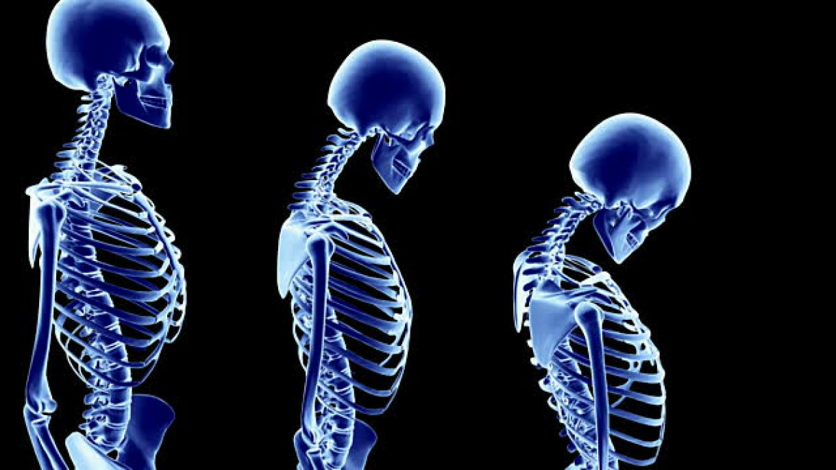 Osteoporosis, ¿Cómo prevenirla con remedios naturales?