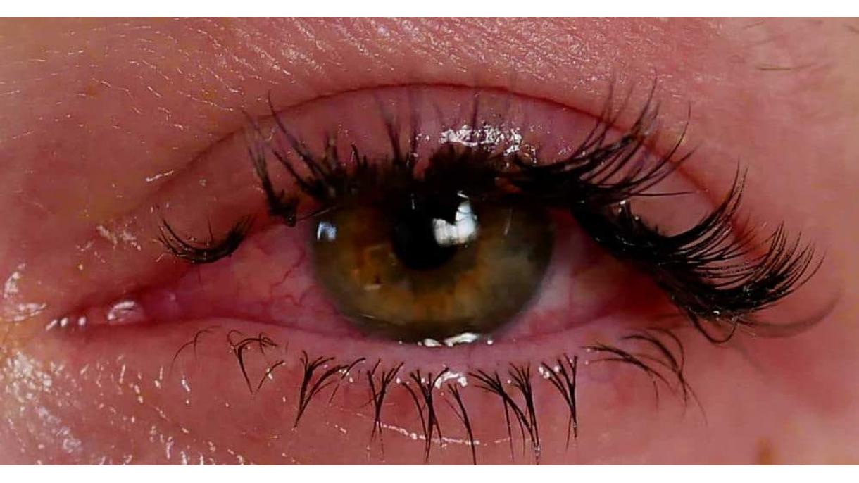 La conjuntivitis alégica: un problema que afecta la calidad de vida