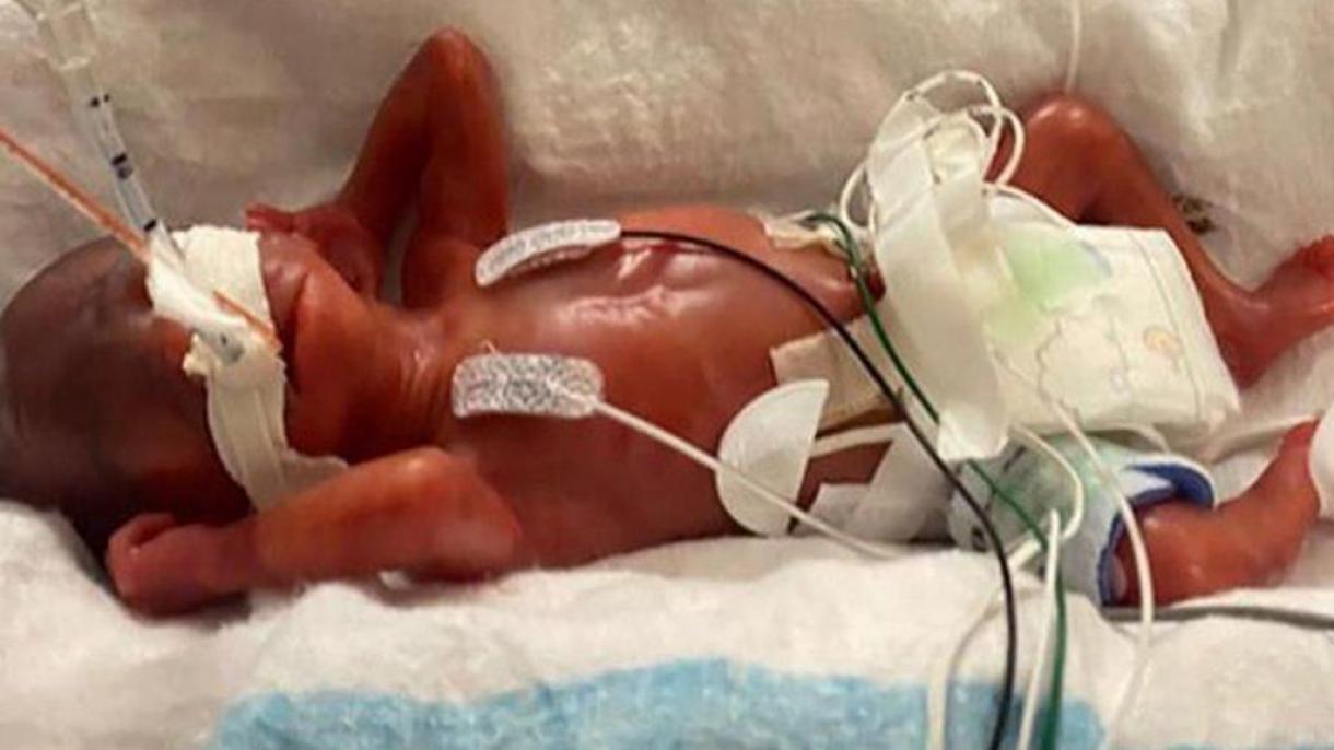 美国男婴以“最早”早产儿被载入吉尼斯世界纪录