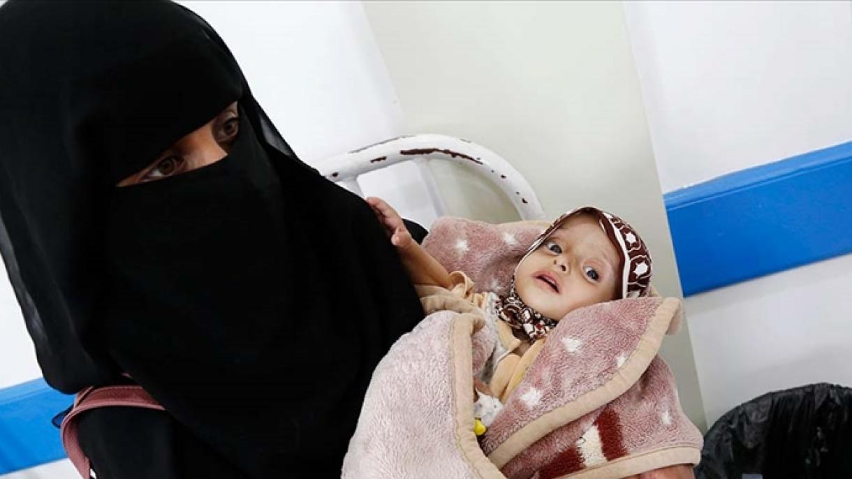 El 75% de los niños yemeníes están desnutridos