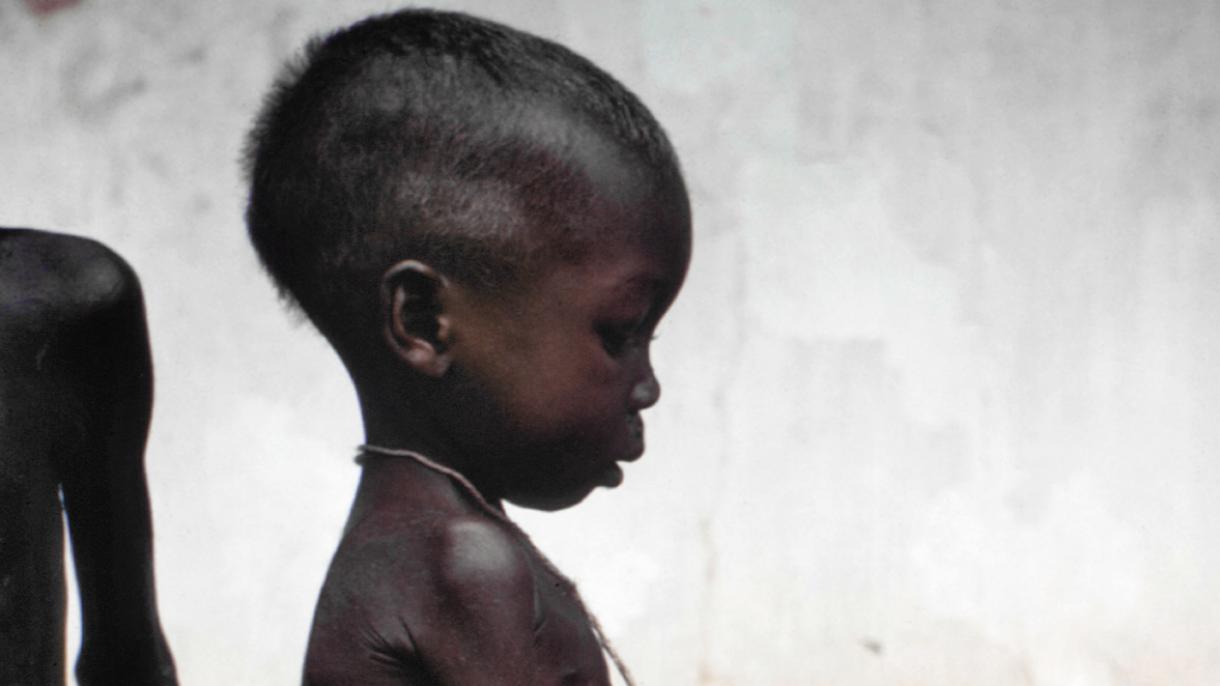 UNICEF diz que 1,4 milhões de crianças correm risco de morrer de fome