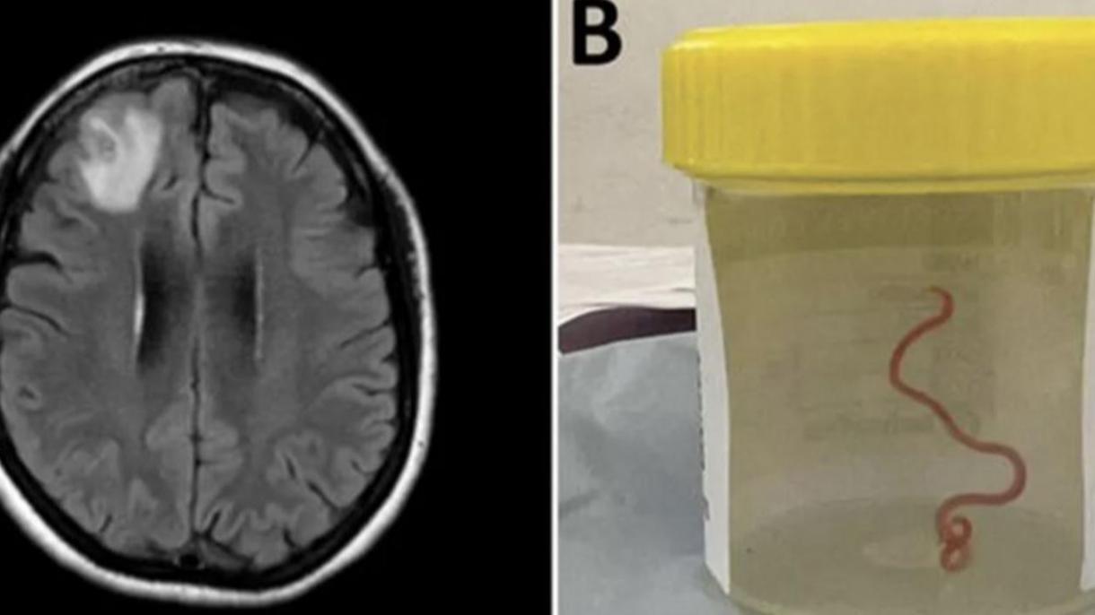 آسٹریلیا: چونسٹھ سالہ مریضہ کے دماغ میں زندہ کیڑا