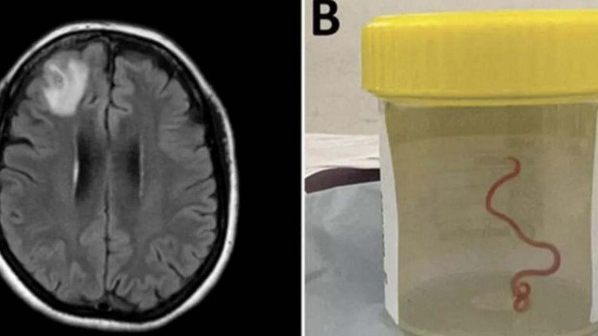 Un vierme viu a fost extras din creierul unei femei