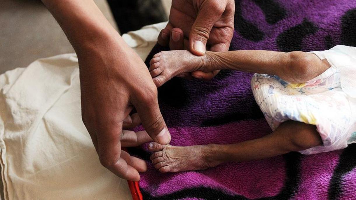 Több tízezer gyerek halt már éhen Jemenben