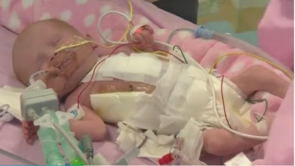 Un bebé con corazón fuera del pecho se opera con éxito