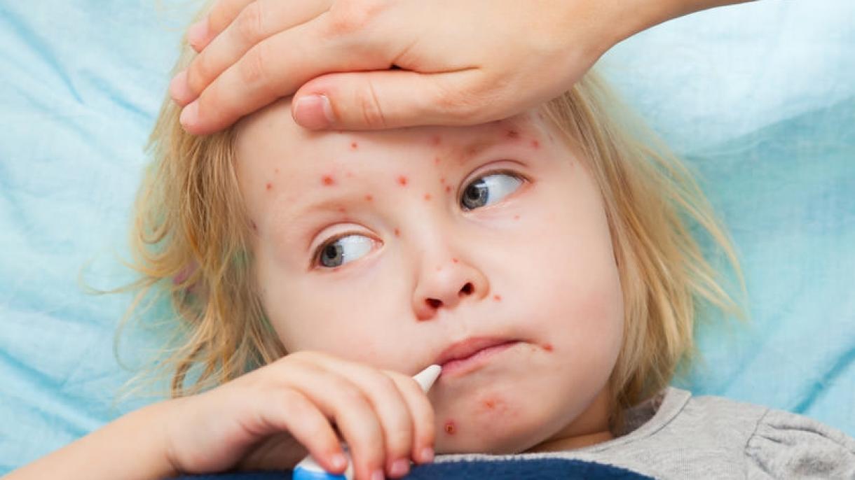 美国麻疹感染人数增至764例